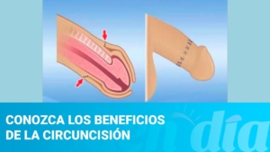 En qué beneficia la circuncisión